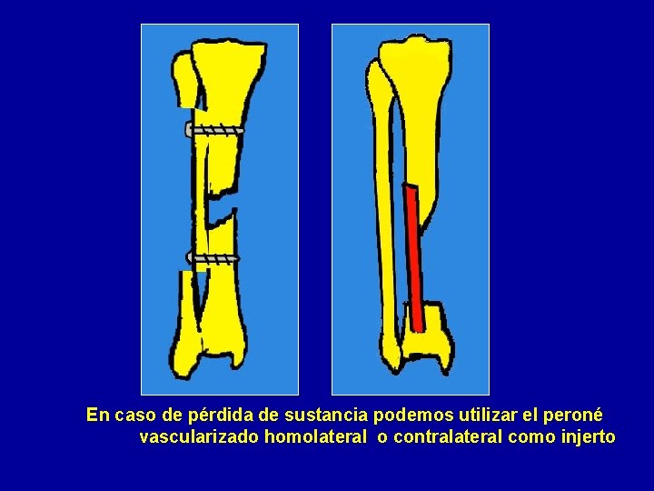 En caso de pérdida de sustancia podemos utilizar el peroné vascularizado homolateral o contralateral