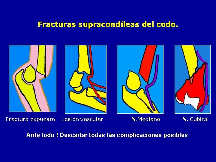 Fracturas supracondíleas del codo. Fractura expuesta Lesion vascular N. Mediano N. Cubital Ante todo
