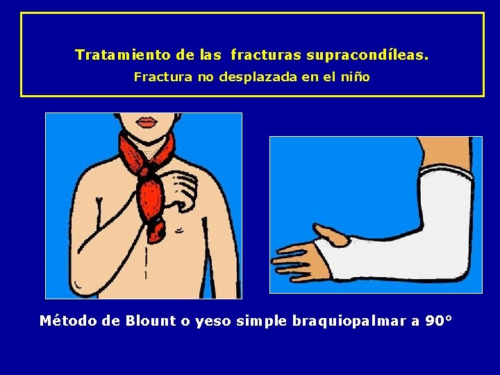 Tratamiento de las fracturas supracondíleas. Fractura no desplazada en el niño Método de Blount