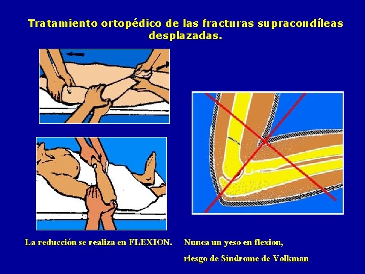 Tratamiento ortopédico de las fracturas supracondíleas desplazadas. La reducción se realiza en FLEXION. Nunca