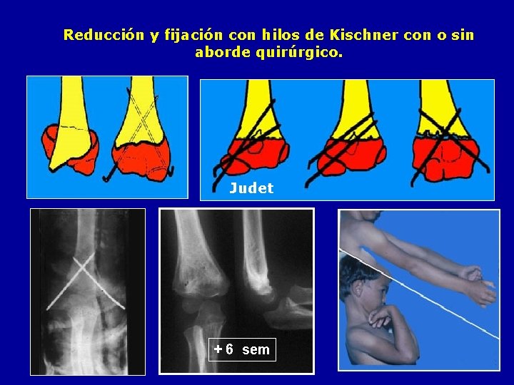 Reducción y fijación con hilos de Kischner con o sin aborde quirúrgico. Judet +