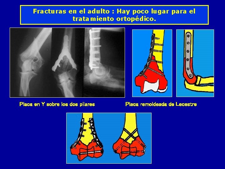 Fracturas en el adulto : Hay poco lugar para el tratamiento ortopédico. Placa en