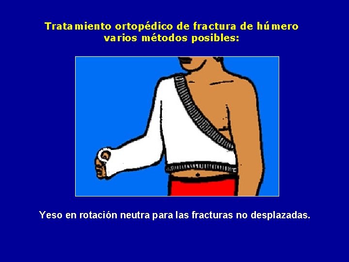 Tratamiento ortopédico de fractura de húmero varios métodos posibles: Yeso en rotación neutra para