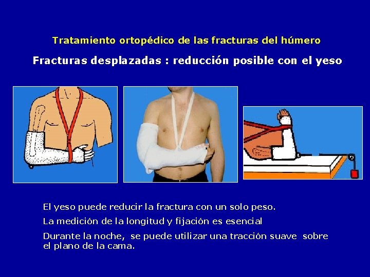 Tratamiento ortopédico de las fracturas del húmero Fracturas desplazadas : reducción posible con el