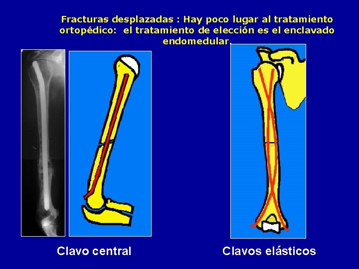 Fracturas desplazadas : Hay poco lugar al tratamiento ortopédico: el tratamiento de elección es
