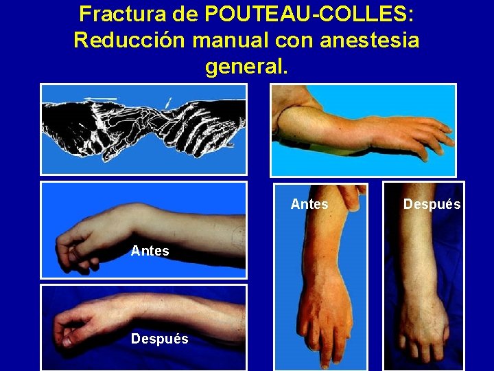 Fractura de POUTEAU-COLLES: Reducción manual con anestesia general. Antes Después 