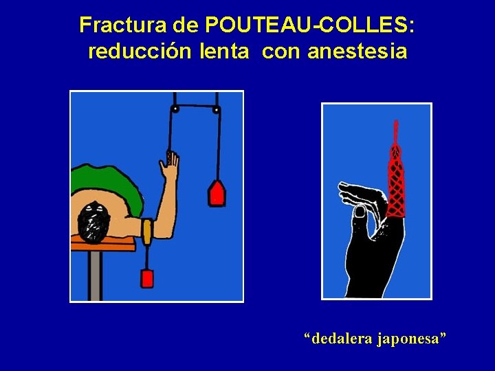 Fractura de POUTEAU-COLLES: reducción lenta con anestesia “dedalera japonesa” 