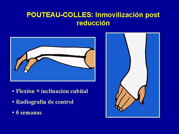 POUTEAU-COLLES: Inmovilización post reducción • Flexión + inclinación cubital • Radiografía de control •
