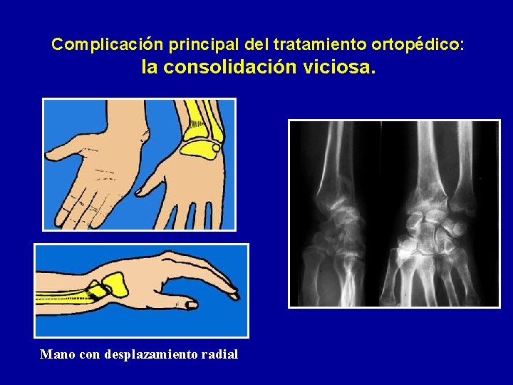 Complicación principal del tratamiento ortopédico: la consolidación viciosa. Mano con desplazamiento radial 