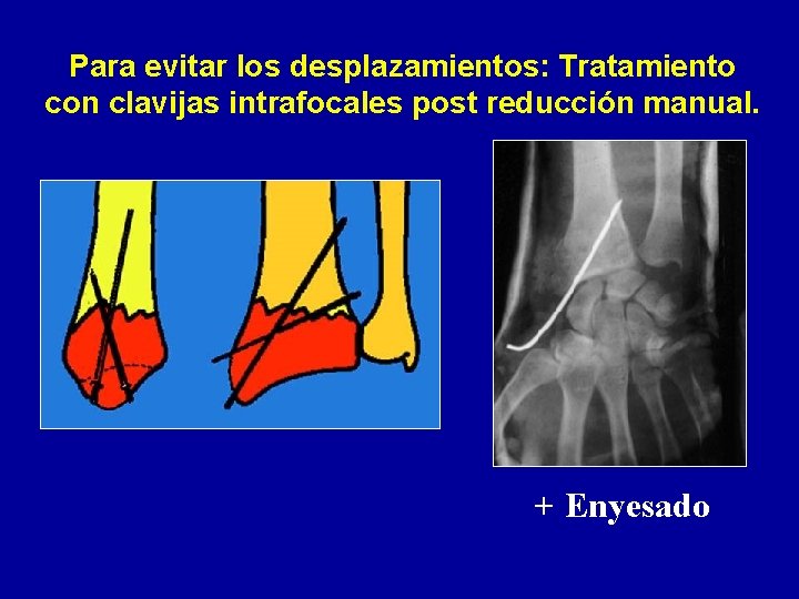Para evitar los desplazamientos: Tratamiento con clavijas intrafocales post reducción manual. + Enyesado 