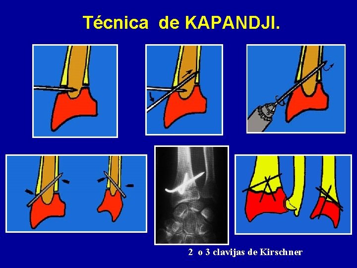 Técnica de KAPANDJI. 2 o 3 clavijas de Kirschner 