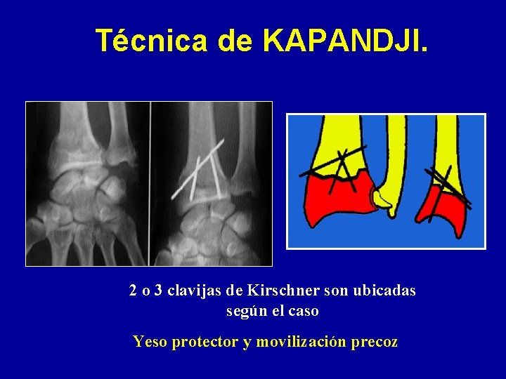 Técnica de KAPANDJI. 2 o 3 clavijas de Kirschner son ubicadas según el caso