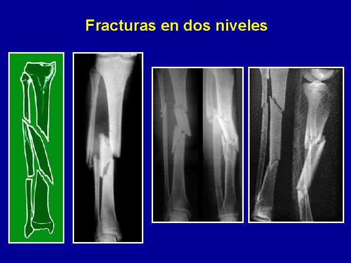 Fracturas en dos niveles 