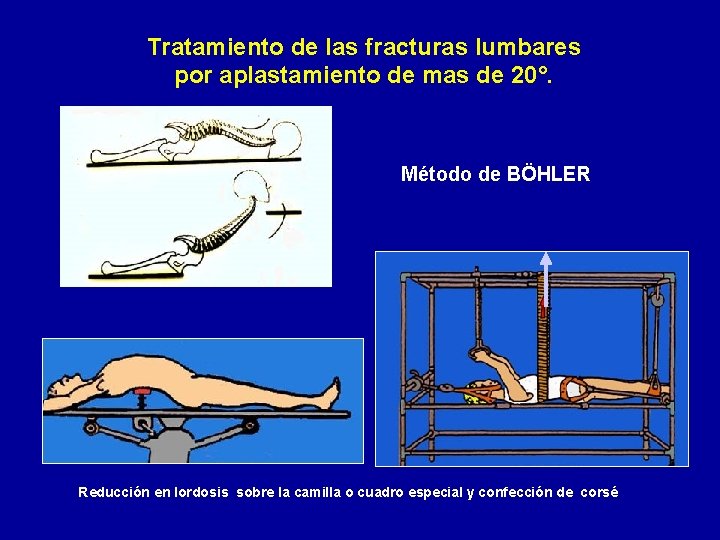 Tratamiento de las fracturas lumbares por aplastamiento de mas de 20°. Método de BÖHLER