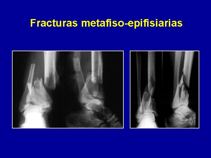 Fracturas metafiso-epifisiarias 