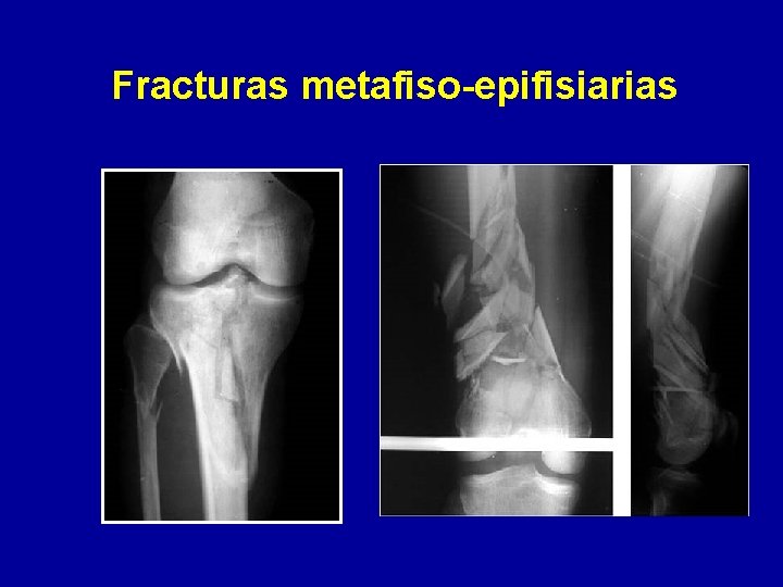 Fracturas metafiso-epifisiarias 