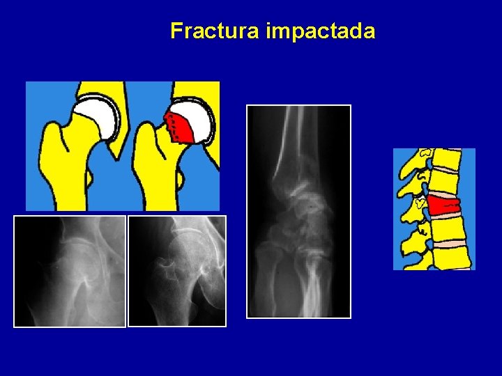 Fractura impactada 