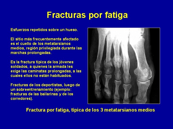 Fracturas por fatiga Esfuerzos repetidos sobre un hueso. El sitio más frecuentemente afectado es