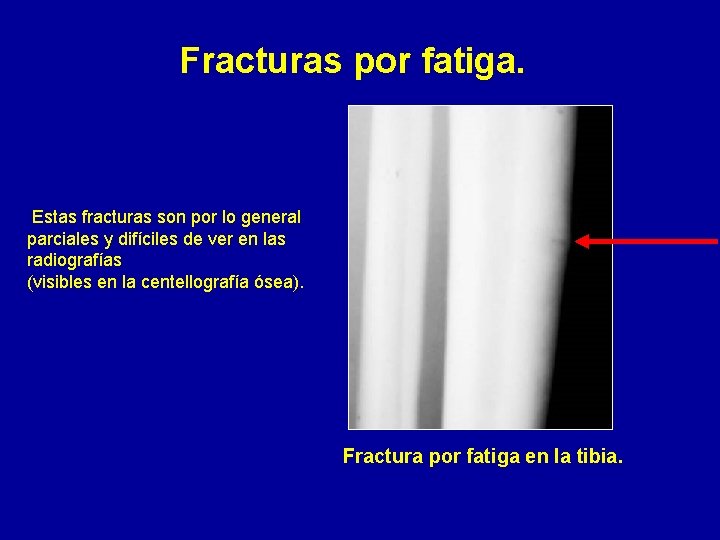 Fracturas por fatiga. Estas fracturas son por lo general parciales y difíciles de ver