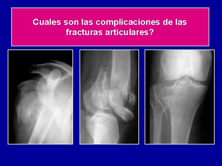 Cuales son las complicaciones de las fracturas articulares? 