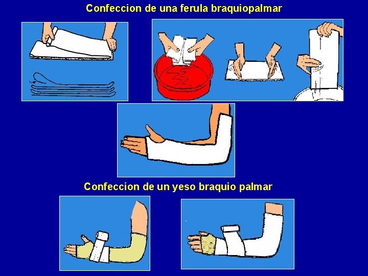 Confeccion de una ferula braquiopalmar Confeccion de un yeso braquio palmar 