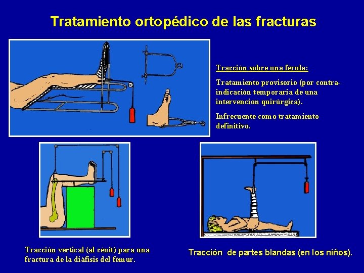 Tratamiento ortopédico de las fracturas Tracción sobre una férula: Tratamiento provisorio (por contraindicación temporaria