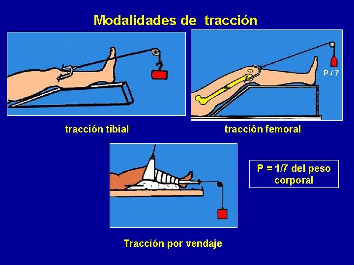 Modalidades de tracción tibial tracción femoral P = 1/7 del peso corporal Tracción por