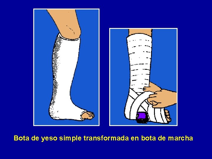Bota de yeso simple transformada en bota de marcha 