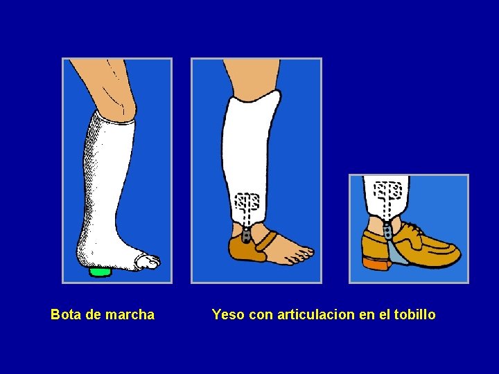 Bota de marcha Yeso con articulacion en el tobillo 