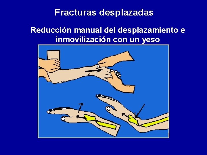 Fracturas desplazadas Reducción manual desplazamiento e inmovilización con un yeso 