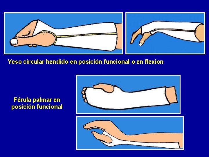 Yeso circular hendido en posición funcional o en flexion Férula palmar en posición funcional
