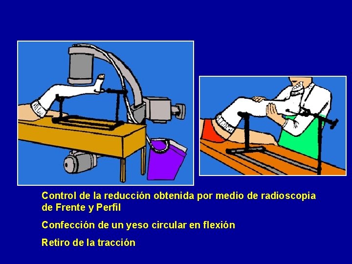 Control de la reducción obtenida por medio de radioscopia de Frente y Perfil Confección