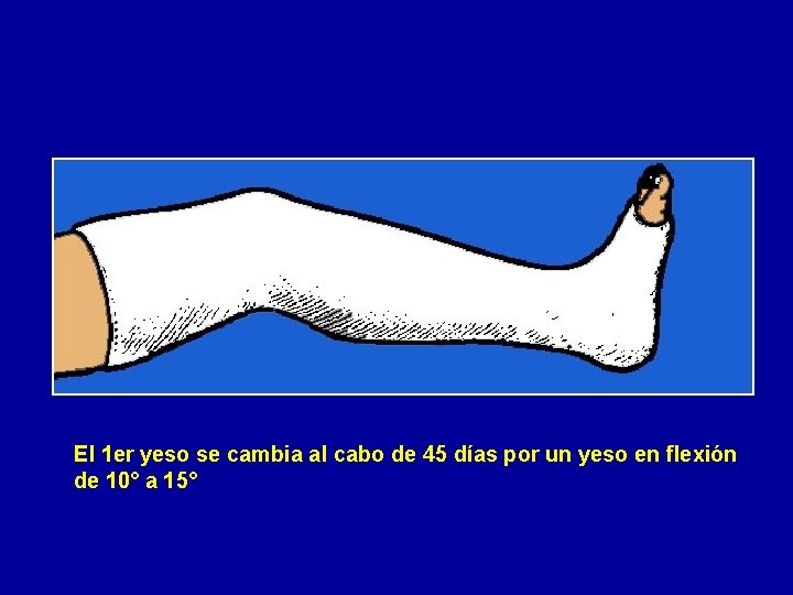 El 1 er yeso se cambia al cabo de 45 días por un yeso