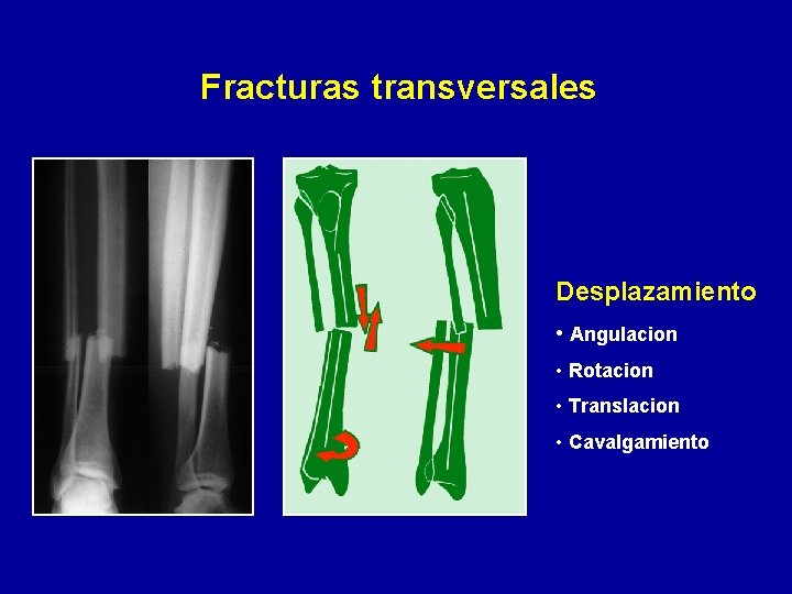 Fracturas transversales Desplazamiento • Angulacion • Rotacion • Translacion • Cavalgamiento 