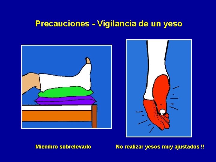 Precauciones - Vigilancia de un yeso Miembro sobrelevado No realizar yesos muy ajustados !!