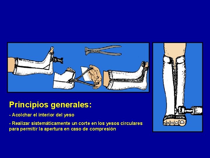Principios generales: - Acolchar el interior del yeso - Realizar sistemáticamente un corte en