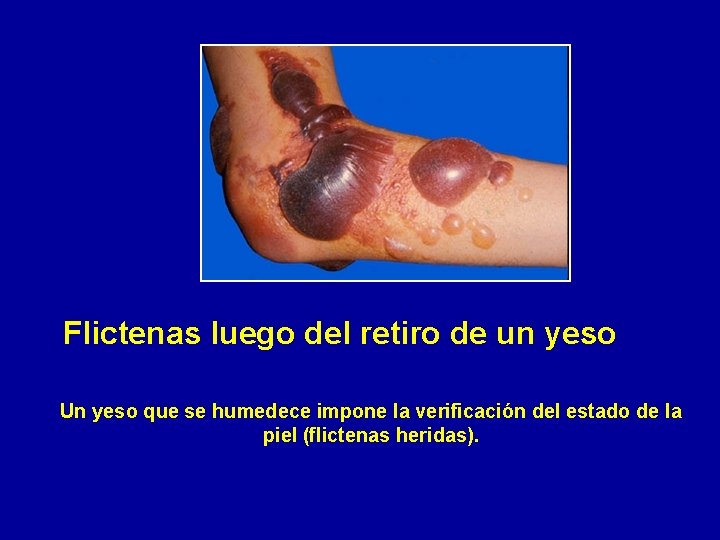 Flictenas luego del retiro de un yeso Un yeso que se humedece impone la