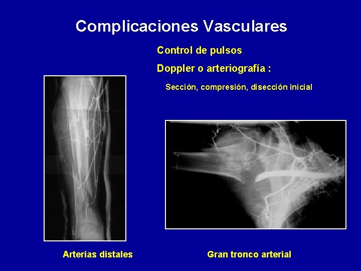 Complicaciones Vasculares Control de pulsos Doppler o arteriografía : Sección, compresión, disección inicial Arterias