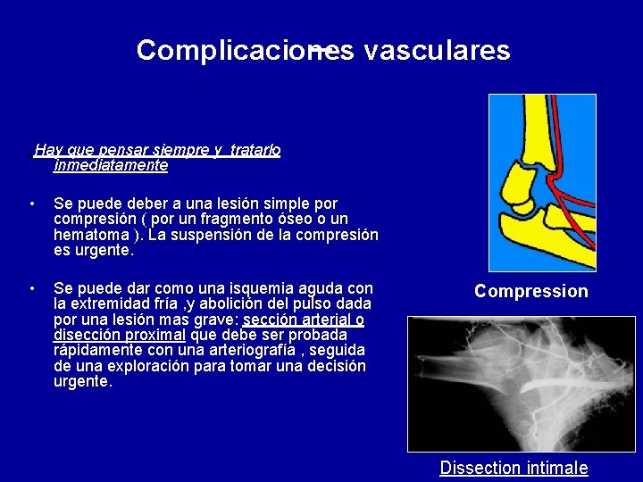 Complicaciones vasculares Hay que pensar siempre y tratarlo inmediatamente • Se puede deber a