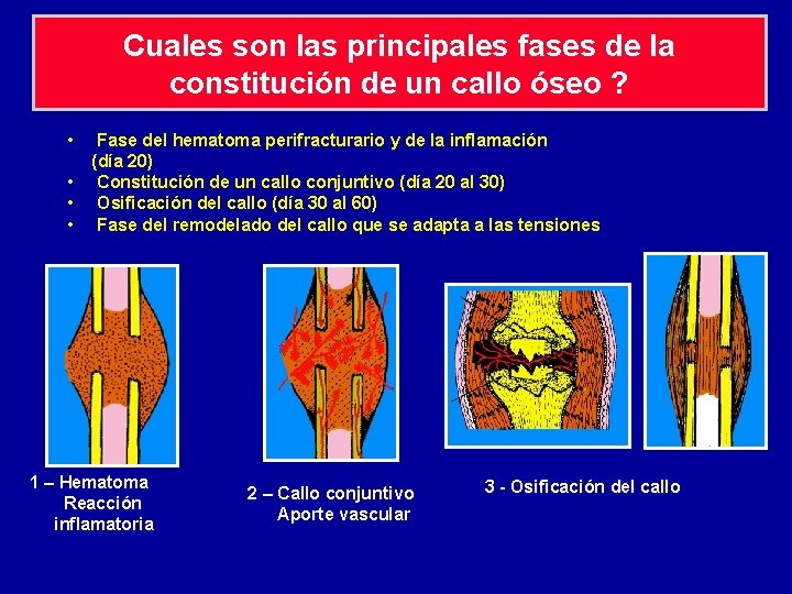Generalidades sobre las Fracturas de los Miembros Desde