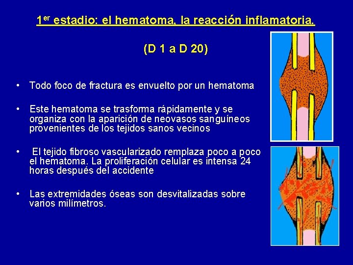 1 er estadio: el hematoma, la reacción inflamatoria. (D 1 a D 20) •