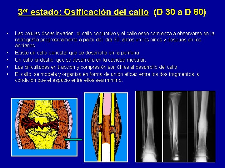 3 er estado: Osificación del callo (D 30 a D 60) • • •