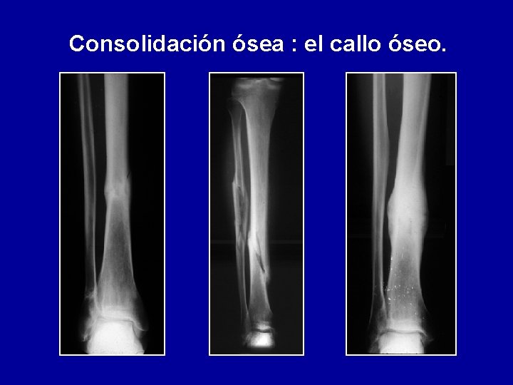 Consolidación ósea : el callo óseo. 