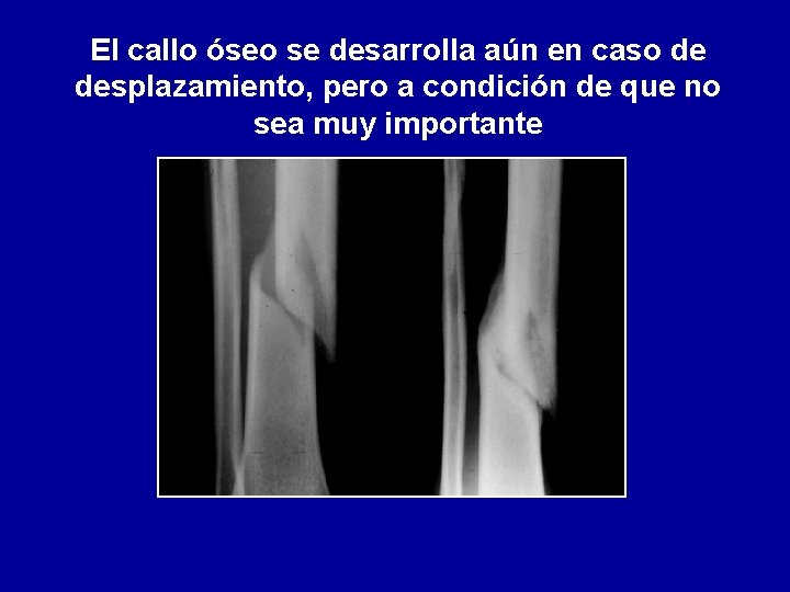 El callo óseo se desarrolla aún en caso de desplazamiento, pero a condición de