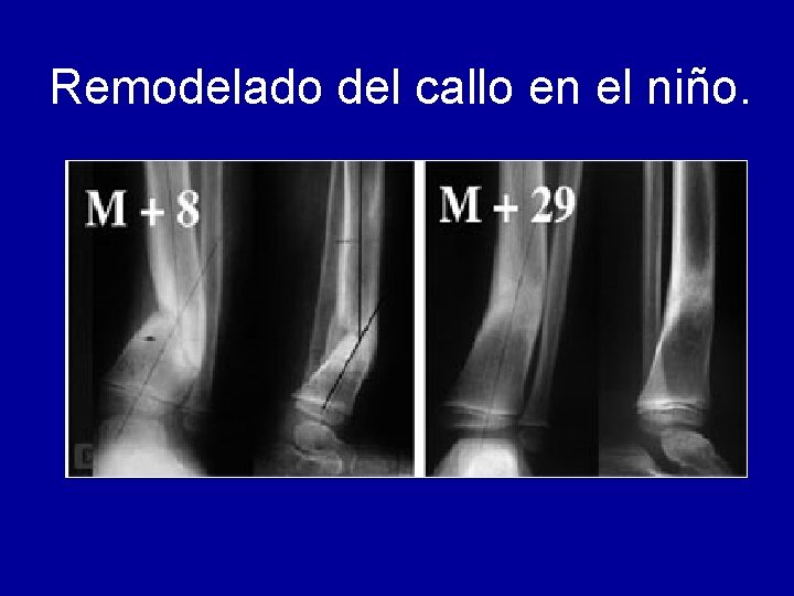Remodelado del callo en el niño. 