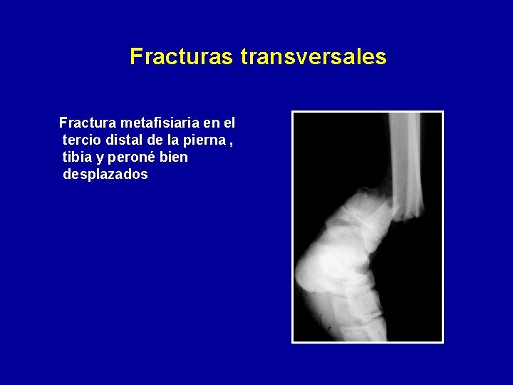 Fracturas transversales Fractura metafisiaria en el tercio distal de la pierna , tibia y