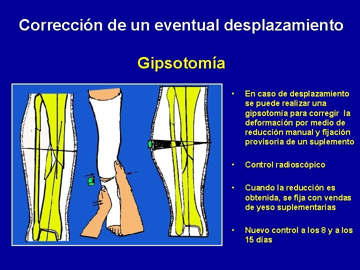 Corrección de un eventual desplazamiento Gipsotomía • En caso de desplazamiento se puede realizar