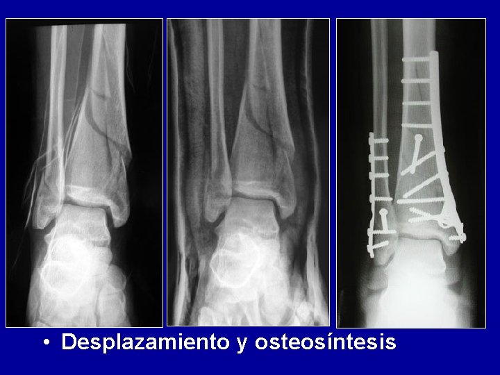  • Desplazamiento y osteosíntesis 