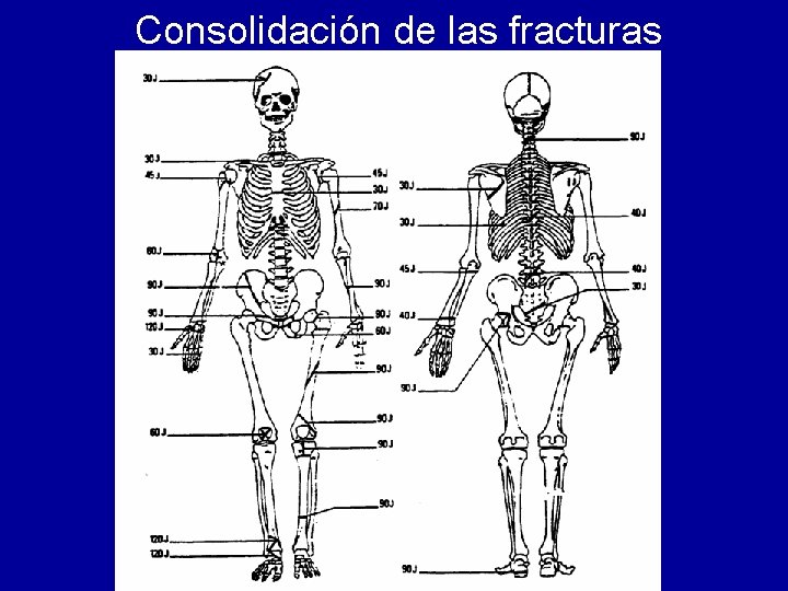 Consolidación de las fracturas 