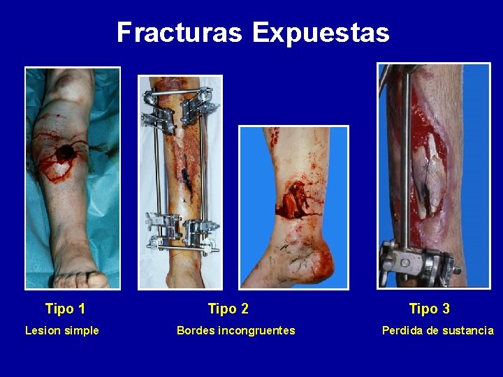 Fracturas Expuestas Tipo 1 Lesion simple Tipo 2 Bordes incongruentes Tipo 3 Perdida de